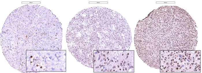 Photomicrographs of immunostaining with anti-PROX1 antibodies in glioblastomas, illustrating the scoring of the proportion of immunoreactive cells set as: &#x2264; 50% (left), 50-90% (middle) or &#x2265; 90% (right) of the total amount of tumor cells.