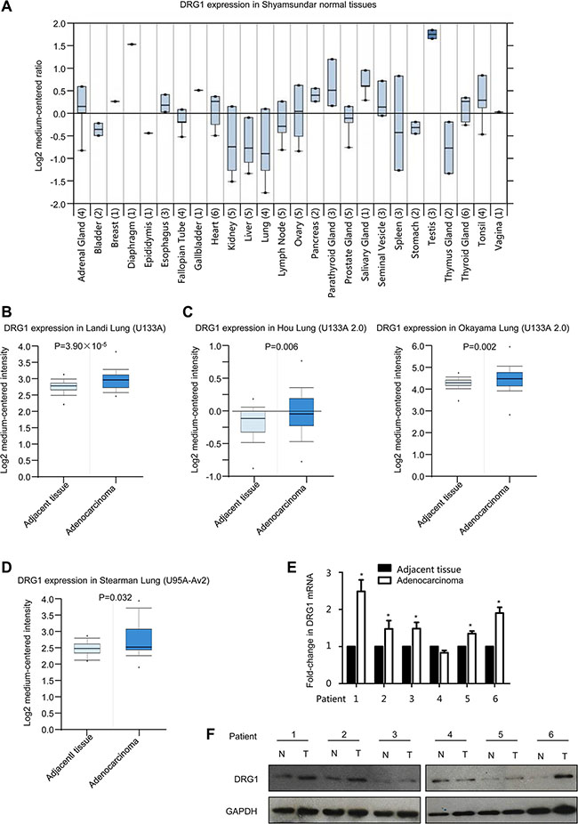 DRG1 is up-regulated in human lung adenocarcinoma.