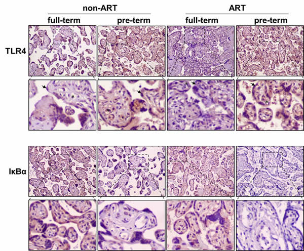 Immunohistochemical staining of TLR4 and I&#x3ba;B&#x3b1; in the placentas of ART/non-ART and full-term/preterm patients.