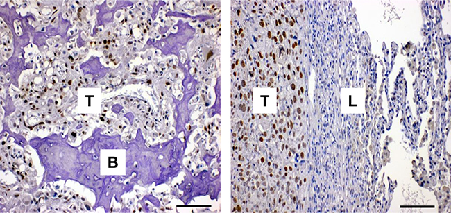 FOXC2 is expressed in human osteosarcoma.