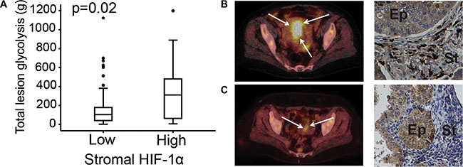 Stromal HIF-1&#x03B1; protein expression correlated to 18FDG PET/CT markers.