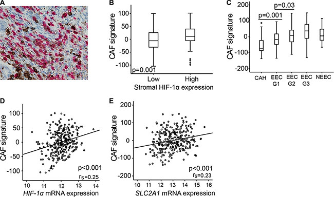 Carcinoma associated fibroblasts (CAFs) gene signature overexpressed in lesions of high stromal HIF-1&#x03B1; expression.
