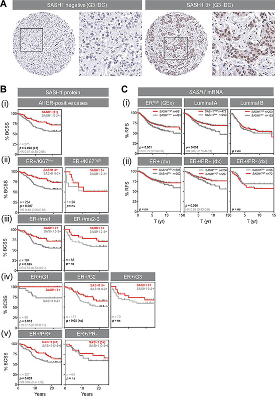 High SASH1 expression is an independent marker of favourable prognosis in ER-positive breast cancer, particularly for low grade and PR co-expressing tumours.