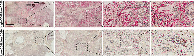 Examples of (A) high CD68 expression and (B) low CD68 expression in patients with pancreatic cancer adenocarcinoma.
