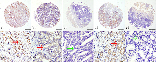 Representation patterns of IDH1-R132H protein expression in gastric benign and malignant tissues in TMA sections.