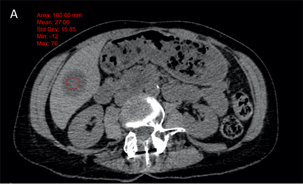 Example of 58 years old female patient, with a submaxillary gland cancer.