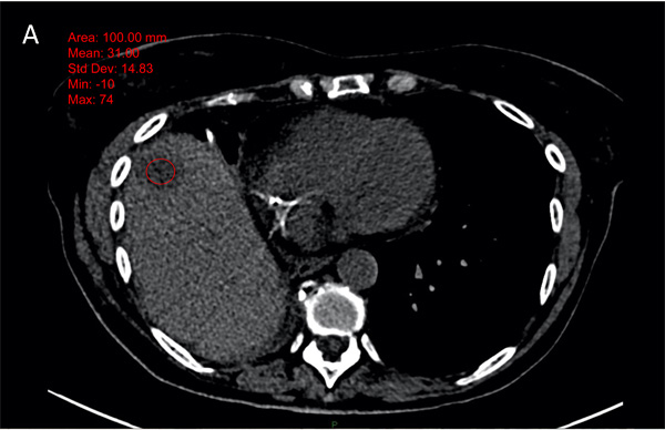 Example of 65 years old male patient, with a lung cancer.