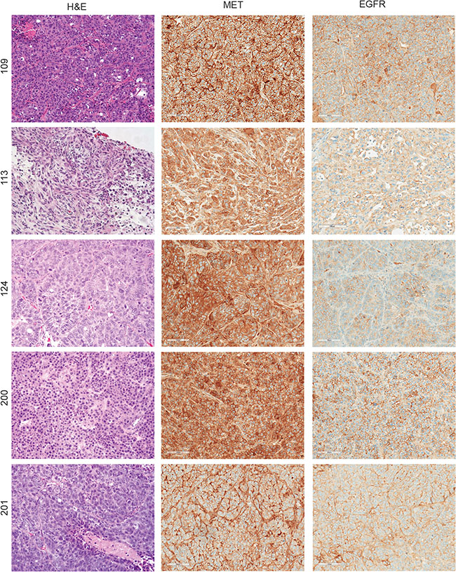 Diversity of MET and EGFR expression in patient-derived TNBC tumorgrafts.