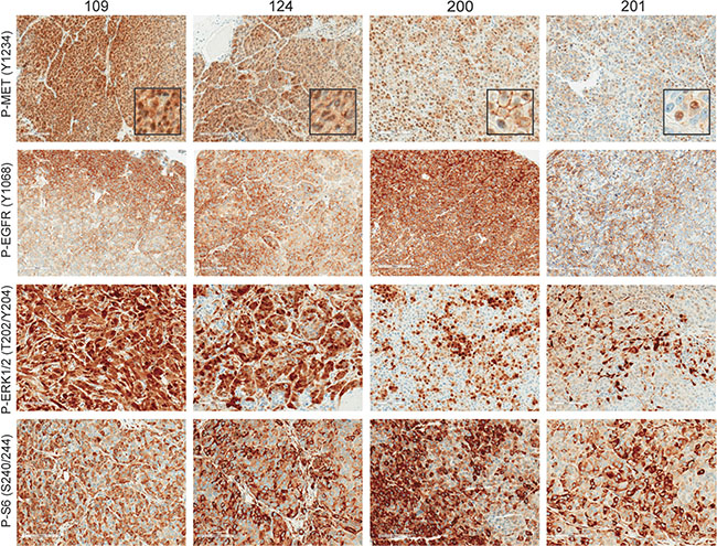 MET and EGFR signaling is highly activated in TNBC.