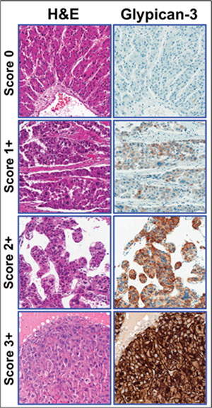Hepatocellular carcinoma tissue samples showing the correlation between staining and clinical score categories.