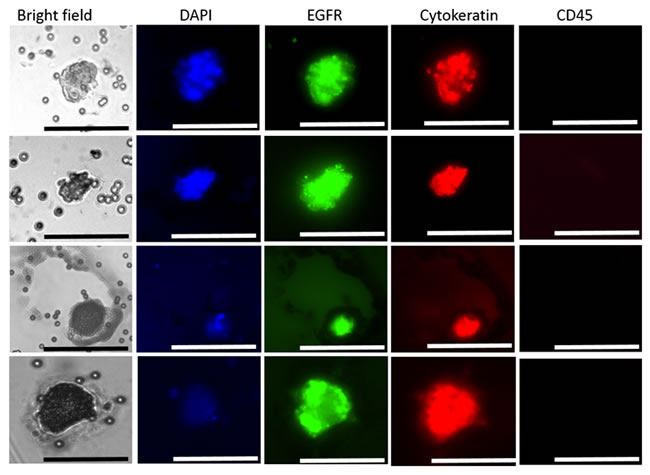 Presentation of selected CTCs in the peripheral blood of HNC patients.