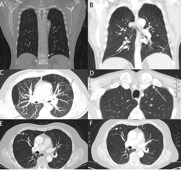 CT scan images of selected HNC patients presenting with suspicious HNC metastasis.