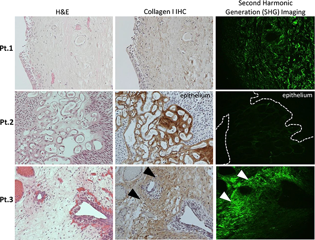 Representative images from individual NMIBC patients demonstrating Hematoxylin &#x0026; Eosin (H&#x0026;E) analysis, Collagen I protein expression by immunohistochemical analysis (IHC) and Second Harmonic Generation (SHG) imaging (20x serial sections from left to right).