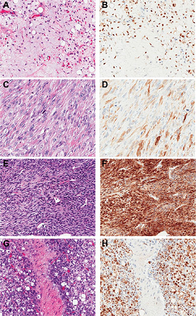 NY-ESO-1 immunohistochemical staining pattern and intensity in liposarcomas and MPNST.