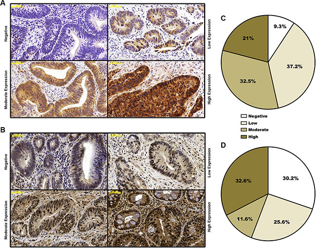 Distribution of staining-based FGFR4 and RAD51 expression in pre-neoadjuvant rectal cancer biopsies.