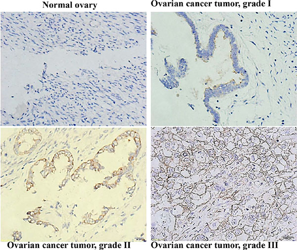 CD133 expression correlated with a high differentiation grade in human ovarian serous cystadenocarcinomas.