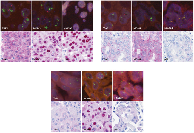 Immunohistochemical stainings for CDK4, MDM2 and p53 (original magnification 250x) and fluorescence in-situ hybridization for CDK4, MDM2 and HMGA2 (original magnification 630x), exemplarily for case M117 A., case K210 B. and case M52 C.