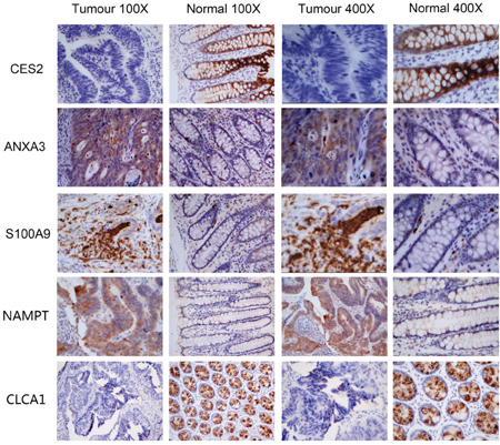 Immunohistochemistry images of S100A9, ANXA3, NAMPT, CES2 and CLCA1.