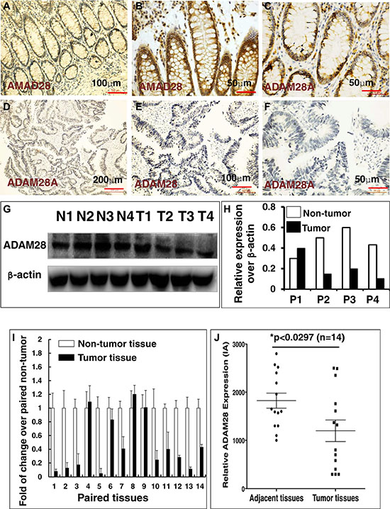 Immunohistochemistry (IHC) staining determined ADAM28 expression in human CRC tumors and matched adjacent tissues.