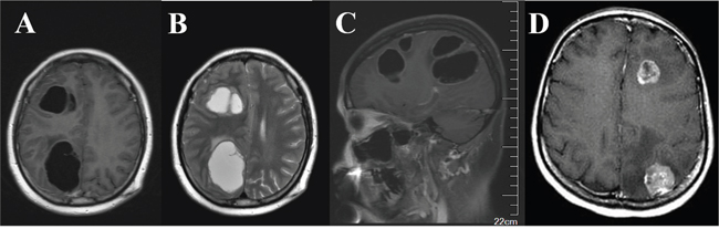 Typical characteristics of cystic versus solid brain metastases observed in MRI images.