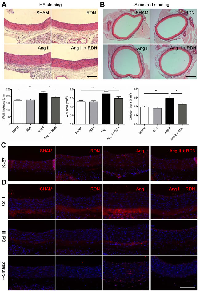 RDN suppresses vascular remodeling.