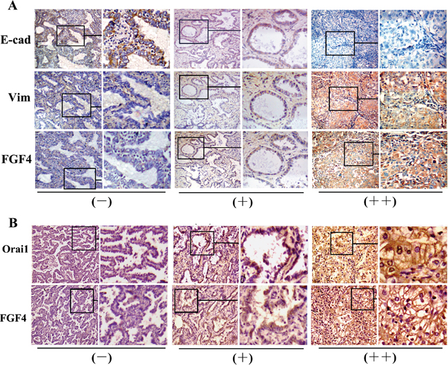 Expression of FGF4 is concomitant with EMT immunohistochemical features and Orai1 expression.