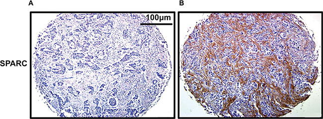 Representative staining of SPARC in gastric cancer tissue by IHC (200&#x00D7;).