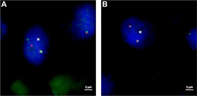 FISH images of ZytoLight SPECTM FGFR3 Dual Color Break Apart Probe sample ID 51.