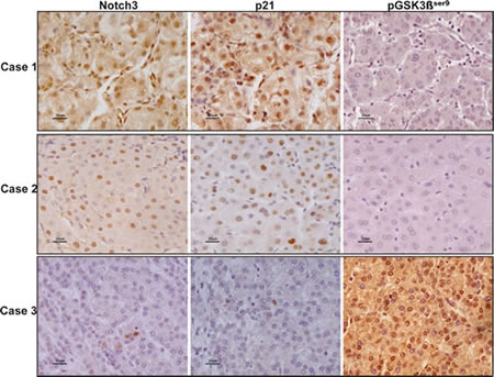 Expression profile of Notch3, p21 and pGSK3&#x3b2;ser9 in human HCC.