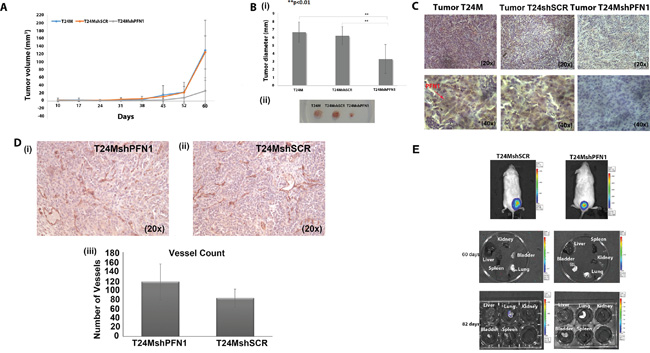 Tumor growth and metastasis analyses in T24M, T24MshSCR and T24MshPFN1 tumor bearing NOD/SCID mice.