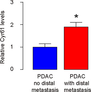Higher Cyr61 levels are detected in PDAC specimens with distal metastasis.