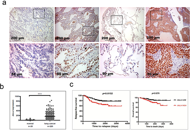 Aberrant SALL4 expression in lung cancer.