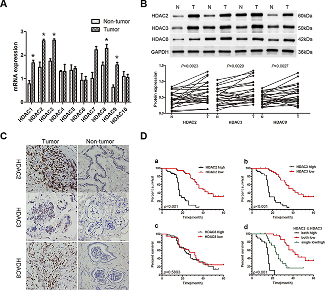 Expression of HDACs in patients with CCA and the correlation of the HDAC2/3 expression with poor prognosis.