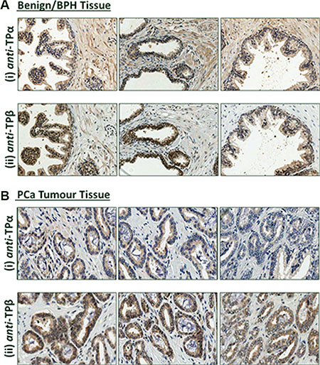 Expression of TP&#x03B1; and TP&#x03B2; in benign prostate and PC&#x03B1; tissue.