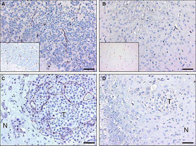 C-C7 recognizes tumor vessels in glioma xenografts and brain metastasis.