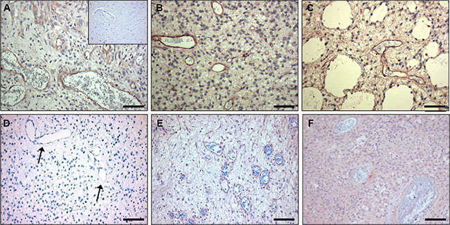 C-C7 recognizes tumor vessels in human glioblastoma multiforme.