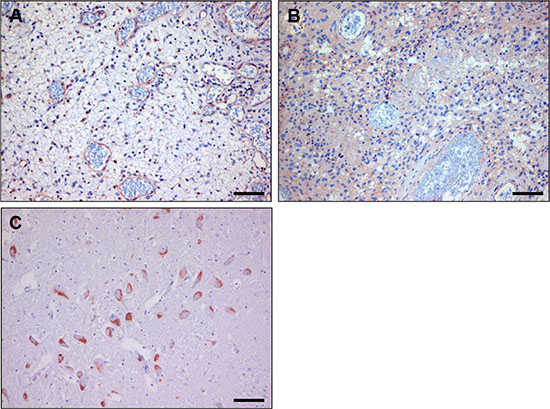 Immunostaining with anti-dynactin-1 -p150Glued of human glioblastoma