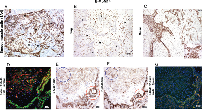 IHC and IF characterisation of stromal and tumoral cells in one GATA-4-positive case.