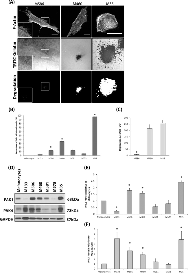 Invasive Patient Derived Cell Strains Overexpress PAK1 and PAK4.
