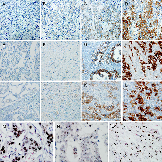 Immunohistochemical (IHC) staining and silver in situ hybridization (SISH) for EGFR, HER2, and MET.