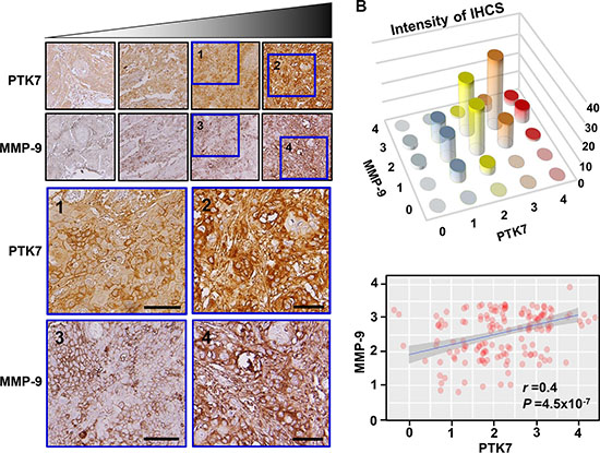 Relationship between PTK7 and MMP-9 expression based on immunohistochemical analysis of ESCC tissue.