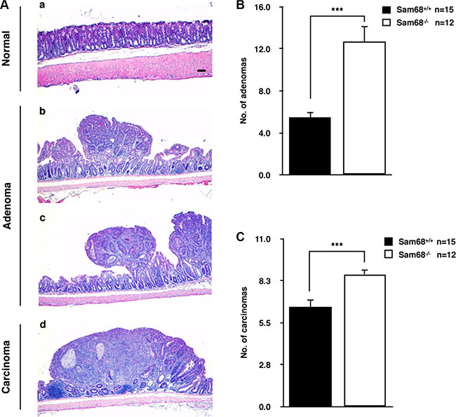 Sam68-deficient mice developed colon tumors with increased malignancy.