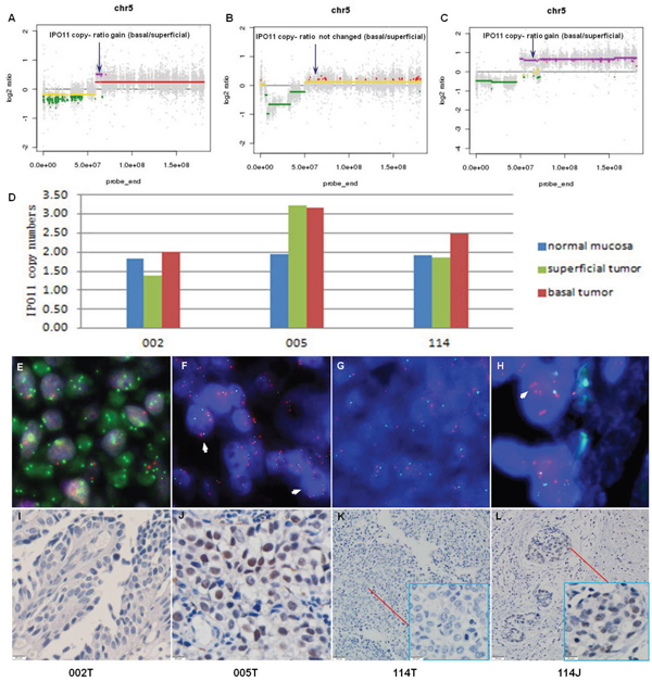 Recurrent copy number variation in IPO11 identified by whole-exome sequencing and confirmed by qPCR and FISH.