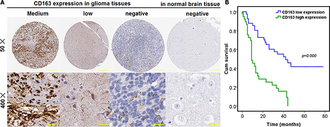 Existence and expression of M2 type macrophage was detected and its prognostic significance was also analyzed in glioma tissues, totaling 90 cases, as well as in paired normal control tissue.