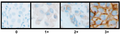 Representative images of HER4 (E200) IHC staining patterns and scoring in invasive breast carcinoma.