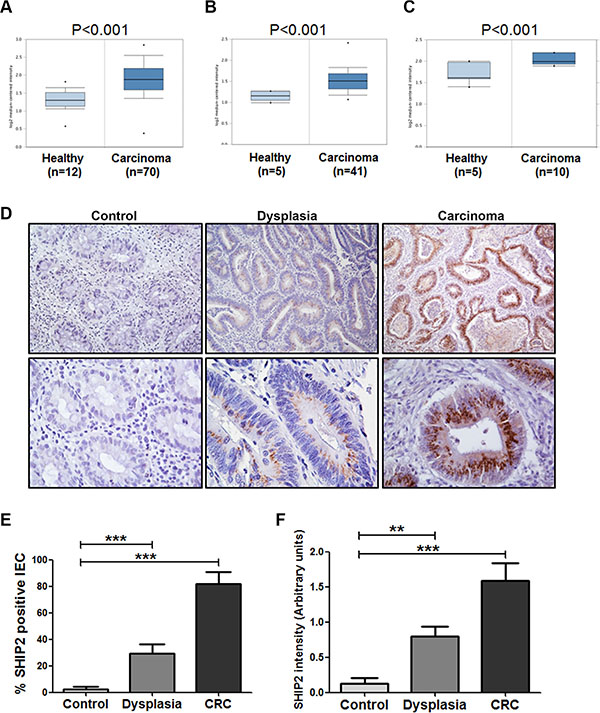 INPPL1 mRNA and SHIP2 protein expression are increased in colorectal dysplasia and carcinoma as compared to non-dysplastic tissue.
