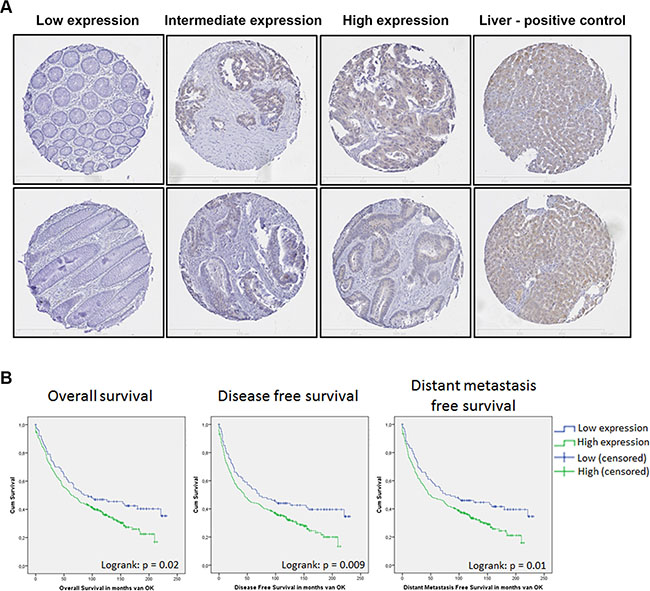 SHIP2 expression in a large cohort of CRC patients is correlated to a worse patient survival.