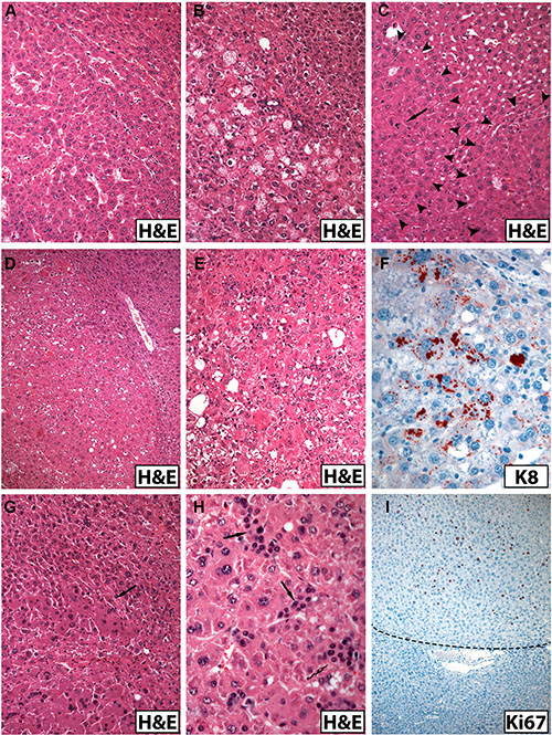 Morphologic spectrum of hepatocellular tumors arising in old male mice (A&#x2013;E, G, H, H&#x0026;E staining; immunohistochemistry in F and I).