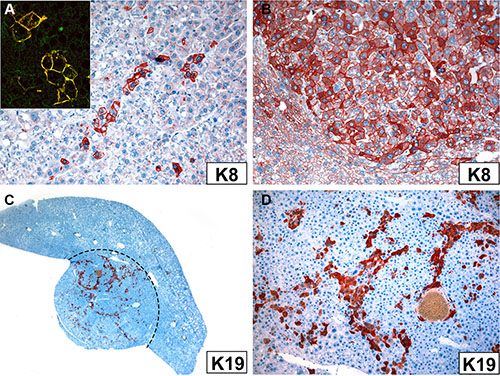 Immunoreactivity of tumor cells in Krt18&#x2212;/&#x2212; (A) and Krt18+/&#x2212; mice (B&#x2013;D) with antibodies to K8 (A, B) and K19 (C, D).