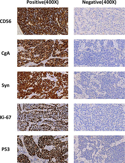 Expression of CD56, CgA, Syn and mutatn p53 in NSCLC.